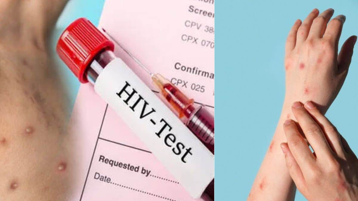 An Italian man becomes first to test positive simultaneously for HIV, Covid-19, and monkeypox