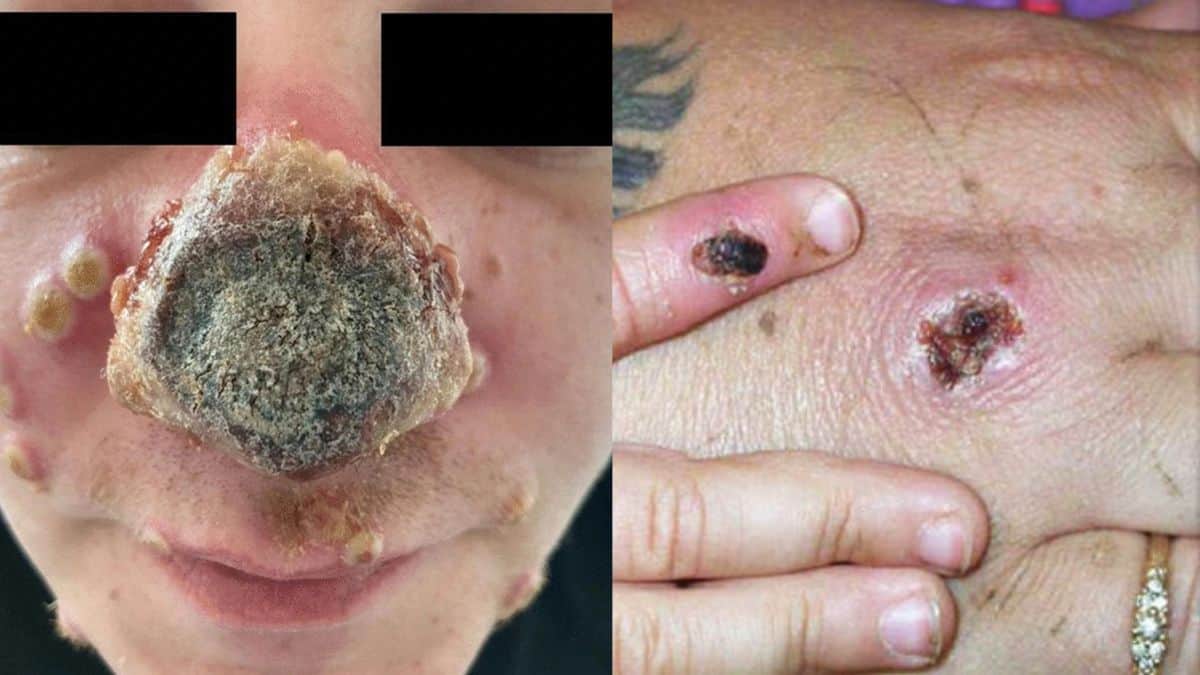 Monkeypox patient's nose is rotting after being dismissed as sunburn